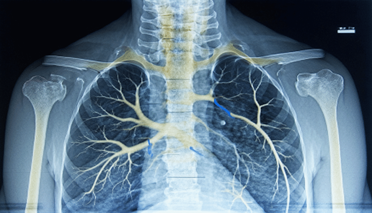 découvrez ce que signifie l'accentuation de la trame broncho-vasculaire dans un compte rendu médical, ses causes possibles et comment elle est interprétée lors des examens d'imagerie des poumons.