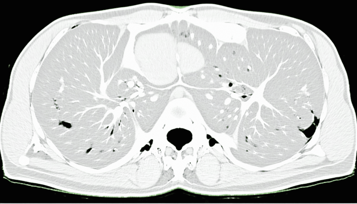 découvrez des témoignages sur le scanner abdomino-pelvien sans injection, mettant en lumière son utilité pour le diagnostic médical et ses limites éventuelles selon l'expérience des patients.